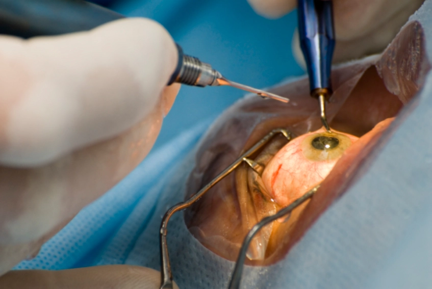 Surgical procedures for cataract removal