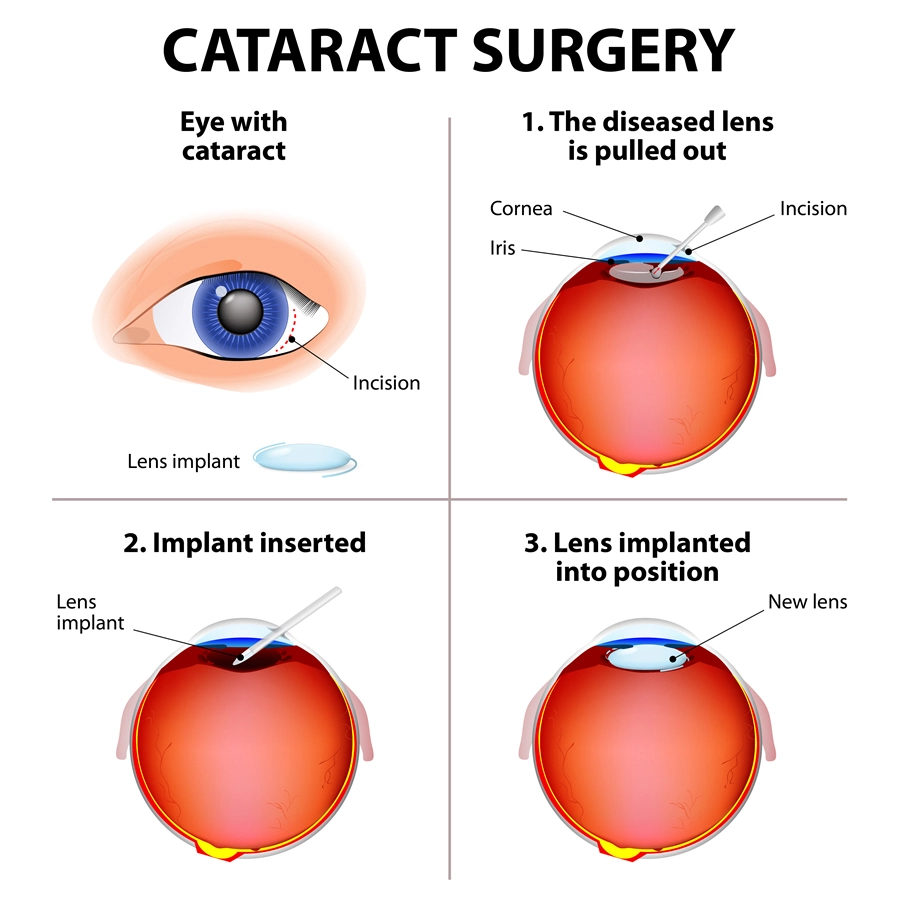 Treatment options for cataract