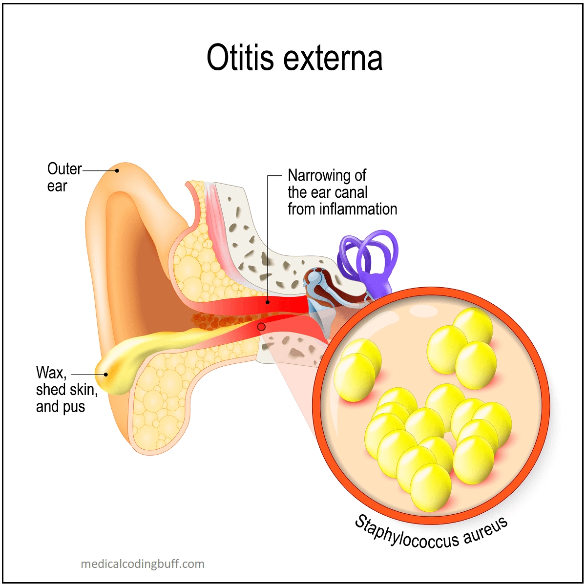 Symptoms and Diagnosis of External Ear Infection