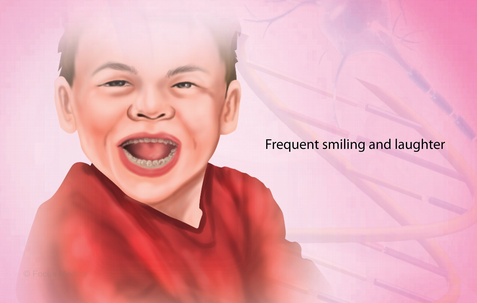 What are the Symptoms of Angelman Syndrome?