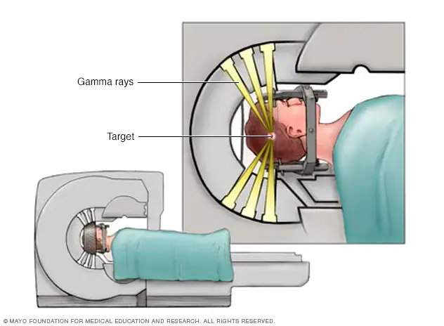 What is Gamma Knife and how does it work?