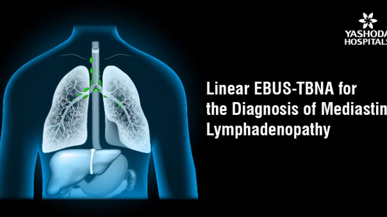 EBUS for the diagnosis of mediastinal lymphadenopathy