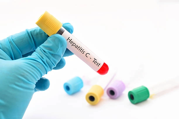 Symptoms and diagnosis of Hepatitis C