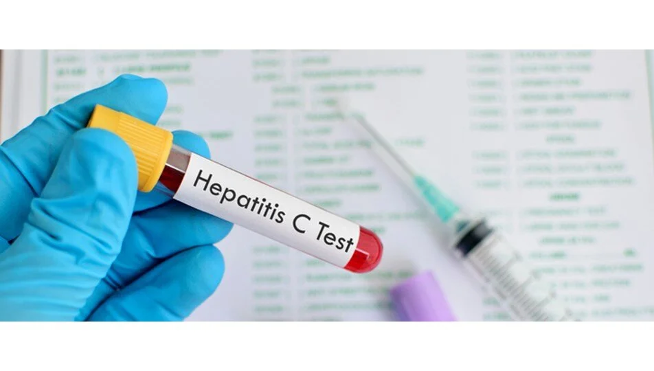 Treatment options for Hepatitis C, including medication and lifestyle changes