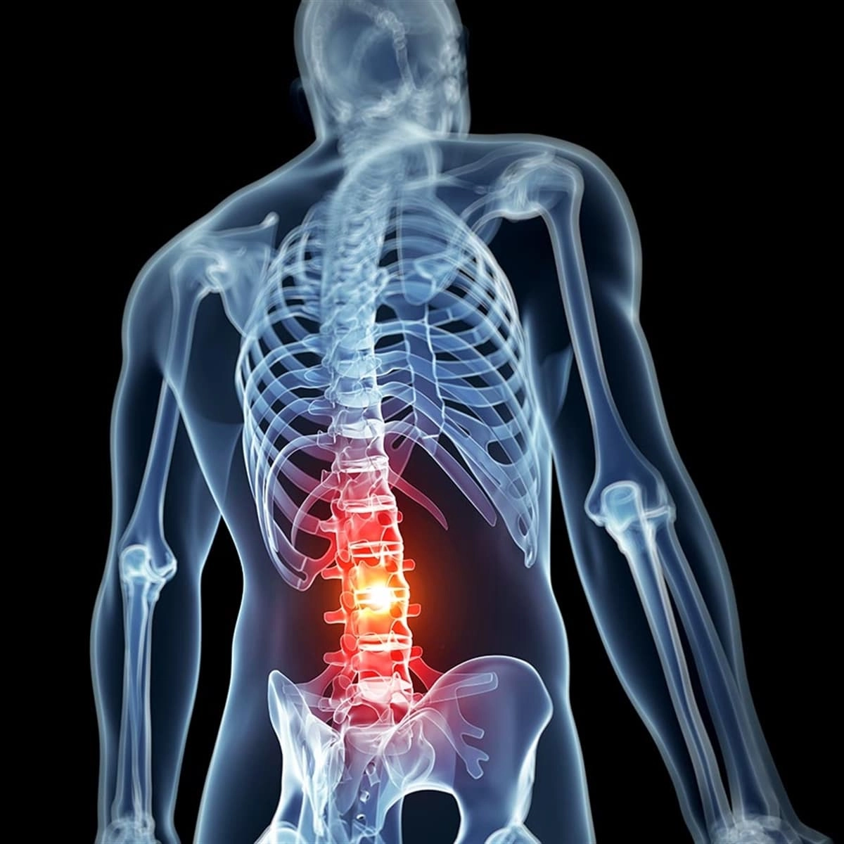 What is a herniated disc in the lower back?
