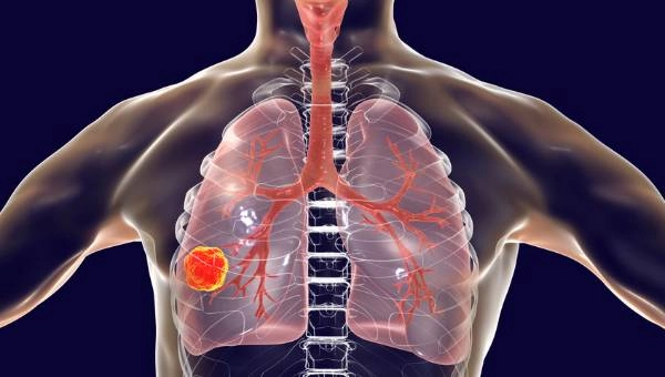Early Warning Signs of Lung Cancer