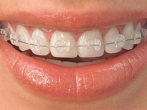 How do invisible braces work?