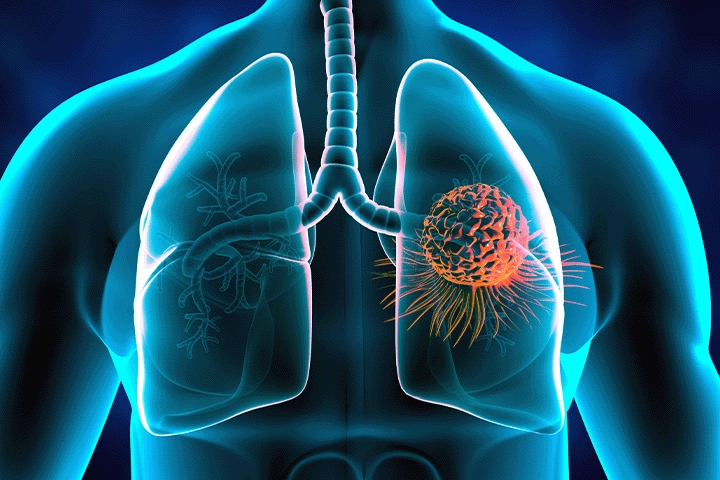 Misdiagnosis and Delayed Diagnosis of Lung Cancer