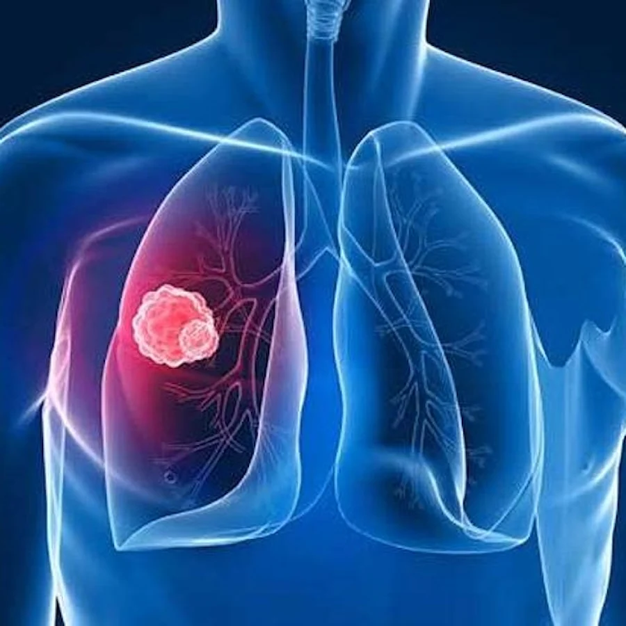 Symptoms of Advanced Stage Lung Cancer