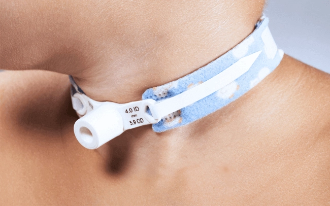 What is a tracheostomy and why is it performed?