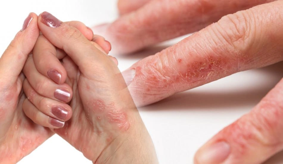 Symptoms and Diagnosis of Contact Dermatitis