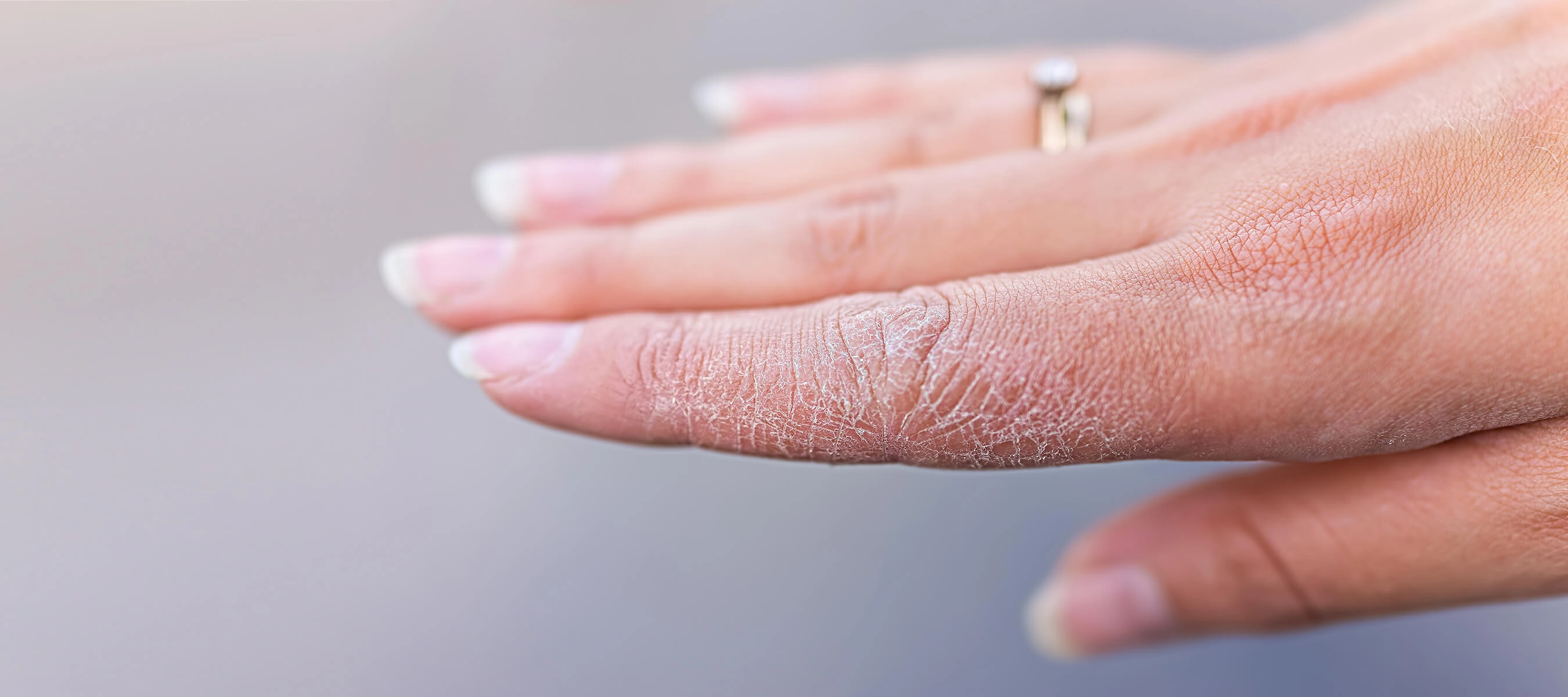 Treatment Options for Contact Dermatitis