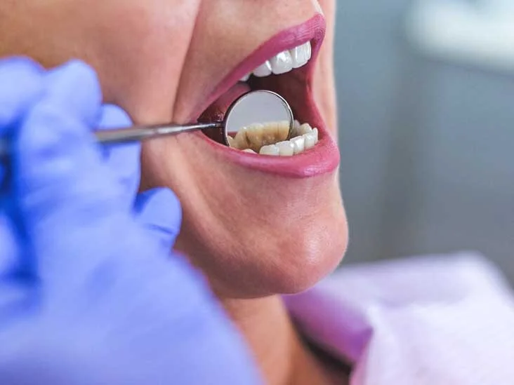 Prevention and Management of Dental Root Abscesses