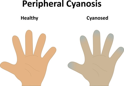 Causes of Cyanosis
