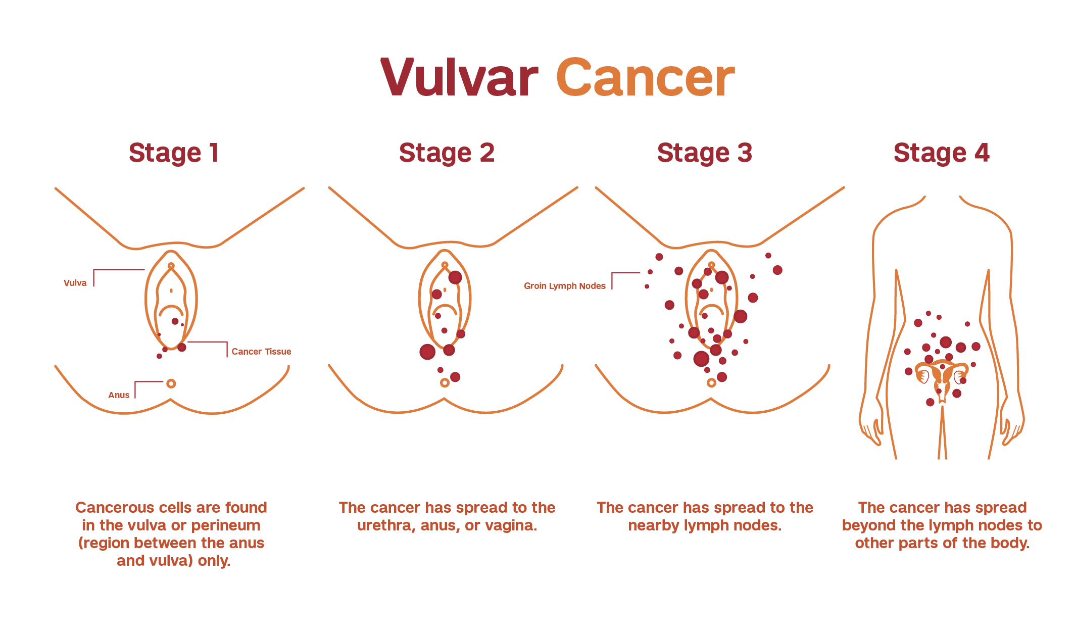 Diagnosis and Staging of Vulvar Cancer