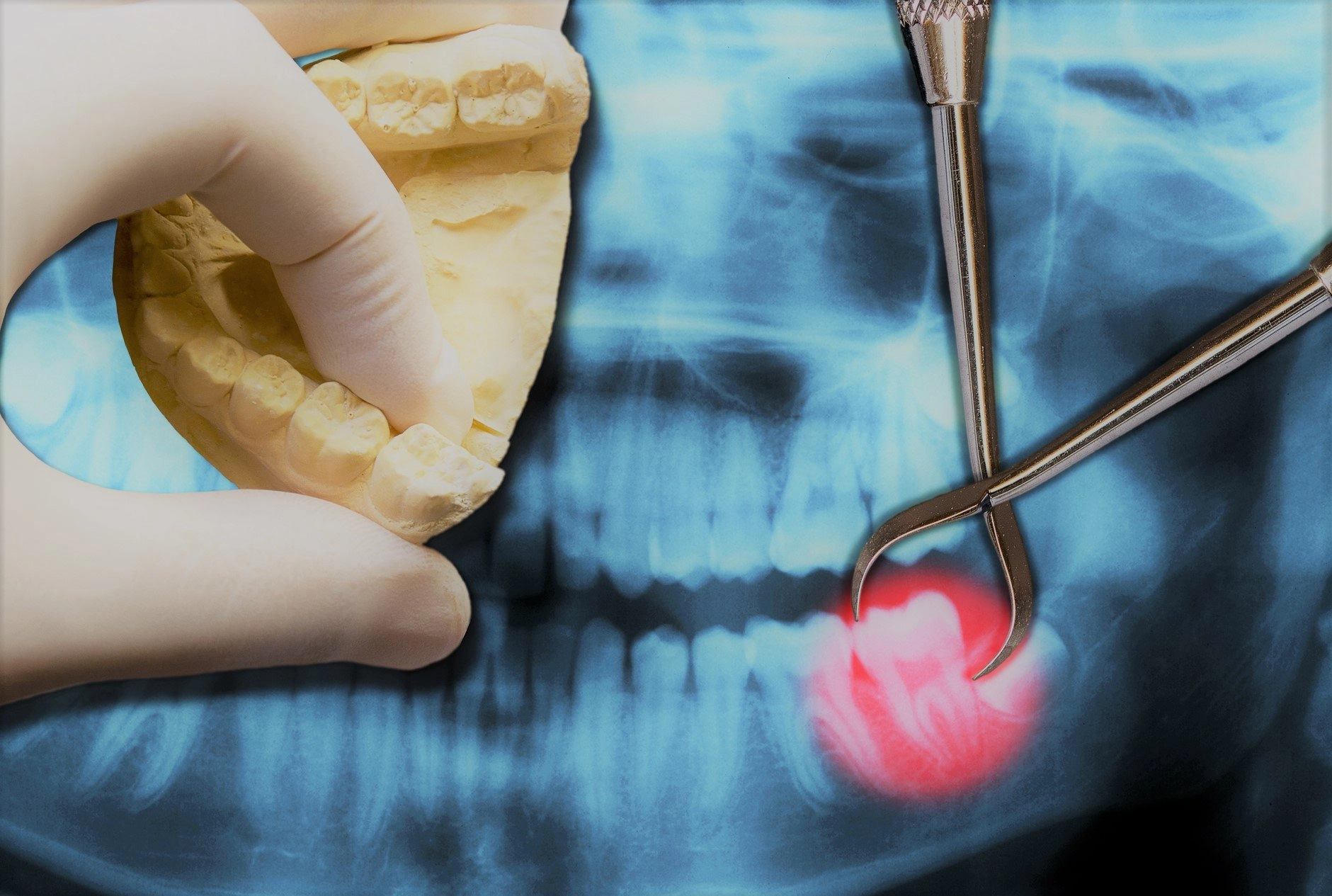The Procedure of Extracting Impacted Wisdom Teeth