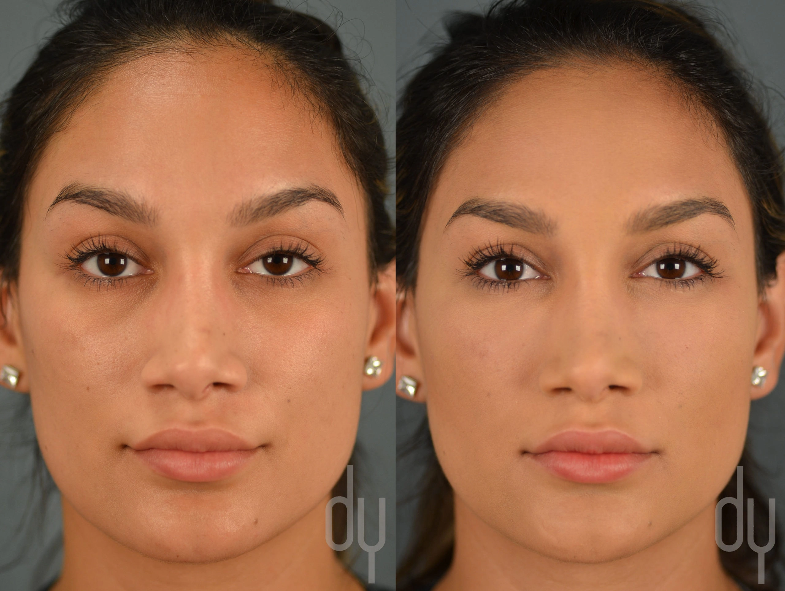 Who is a good candidate for under eye filler injections?