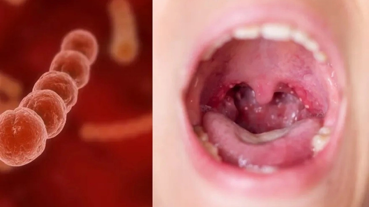 Symptoms of Strep A and when to seek medical attention