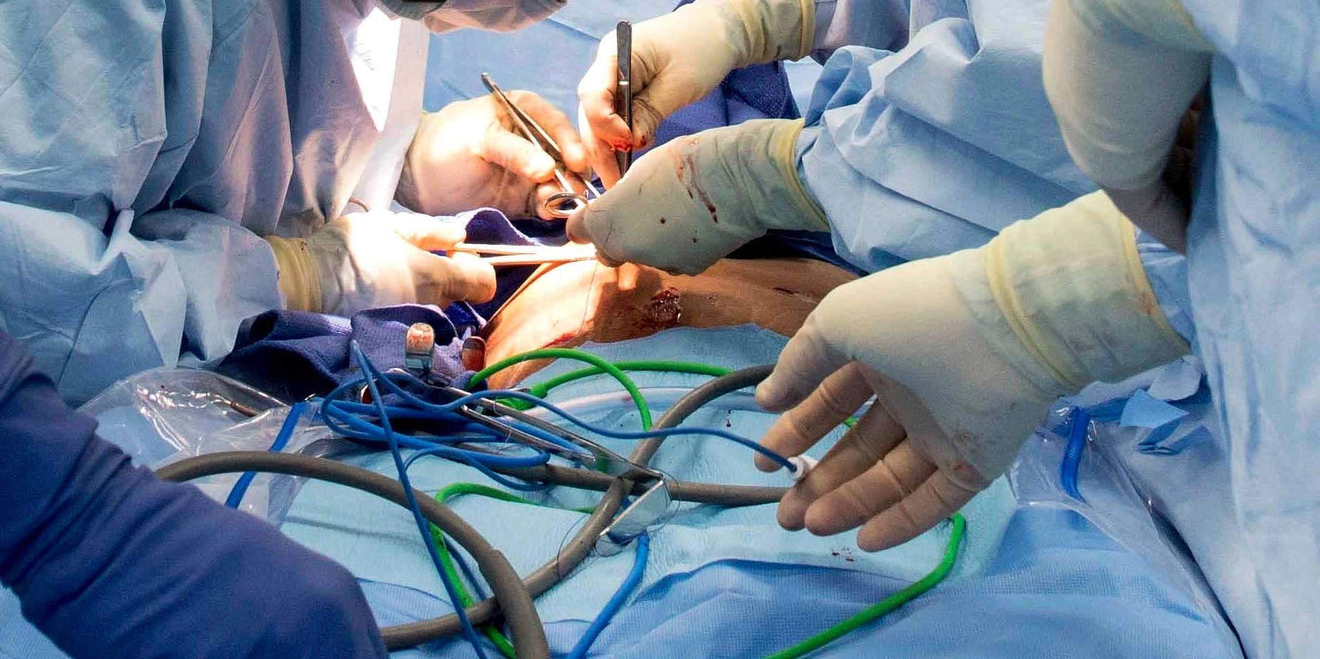 Types of Gallbladder Surgery Procedures