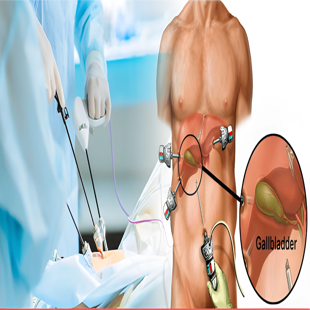 What is Gallbladder Surgery?