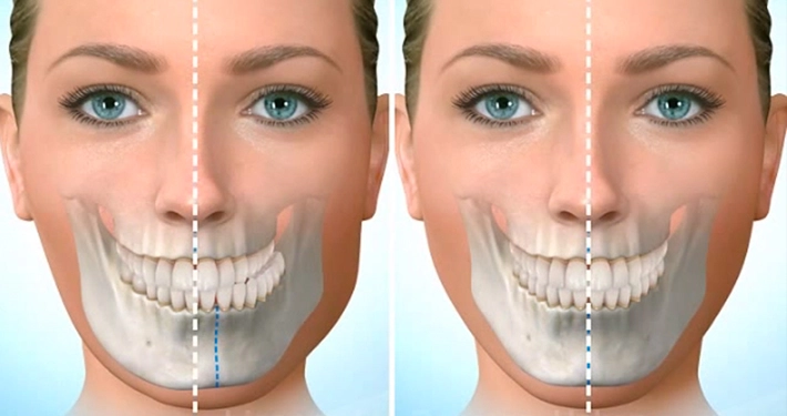 Orthodontic Treatment for Jaw Retrusion