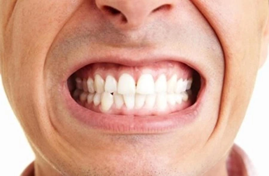 Symptoms and Effects of Teeth Grinding