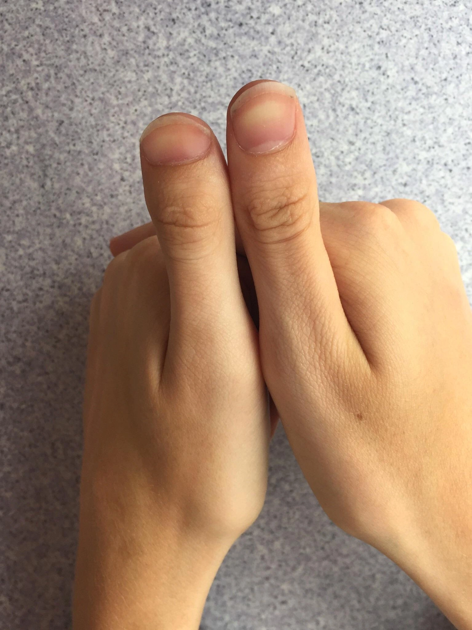 Finger and thumb disorders