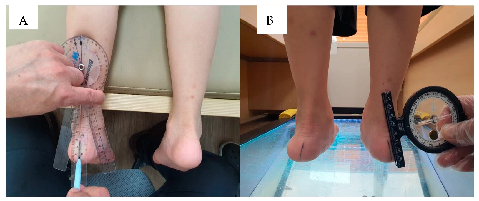 Prevention and Management of Flatfoot