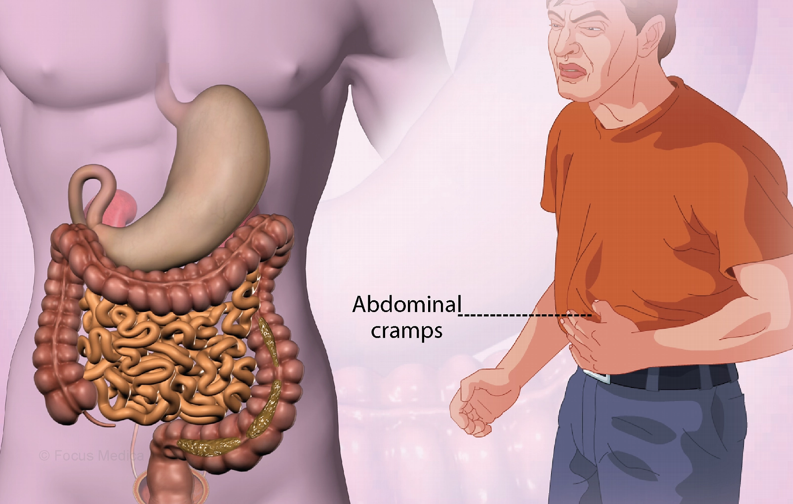 What is Dumping Syndrome?