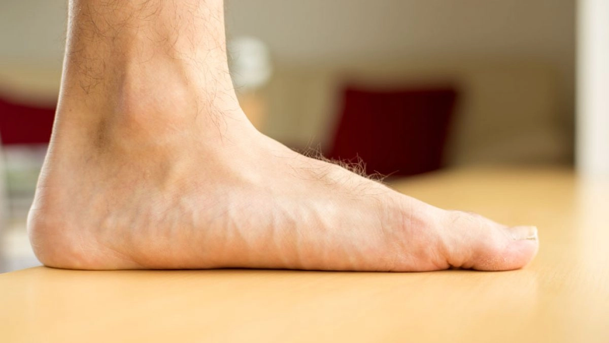 What is Flatfoot and its Causes?