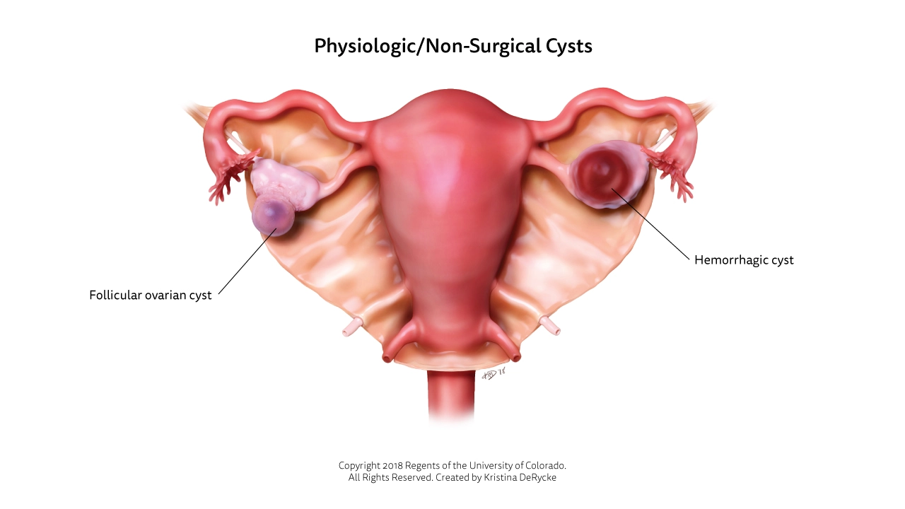 Which Ovarian Cysts Are Dangerous