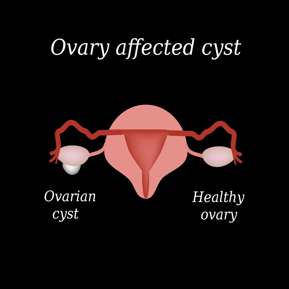 Which Ovarian Cysts are Dangerous?