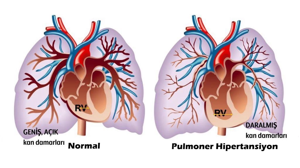 The Impact of Hypertension on the Kidneys