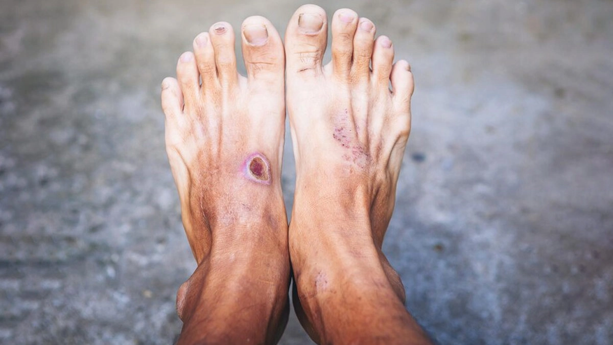 The Relationship Between Diabetes and Foot Ulcers