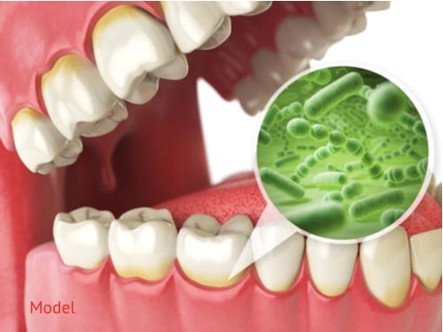 The Impact of Poor Dental Hygiene on Immune System Health