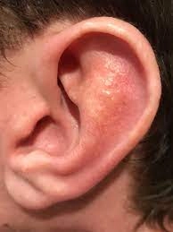 Symptoms and Diagnosis of External Ear Infections