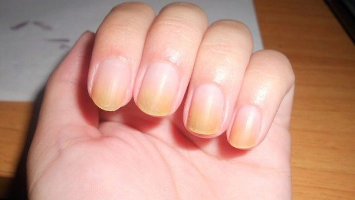 Causes of Yellowing of Nails