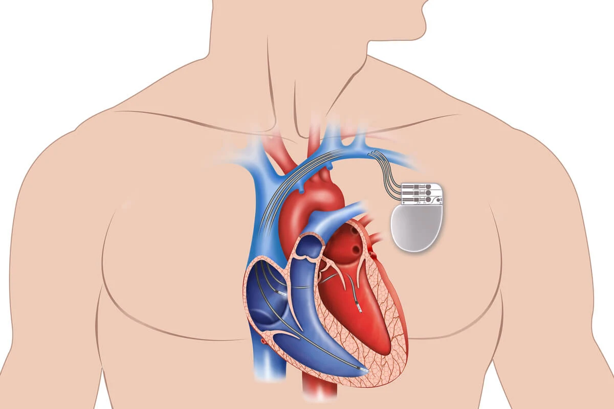 Lifesaving Benefits of Cardiac Pacemakers